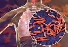 Aumentaron un 38% los casos de tuberculosis en Argentina